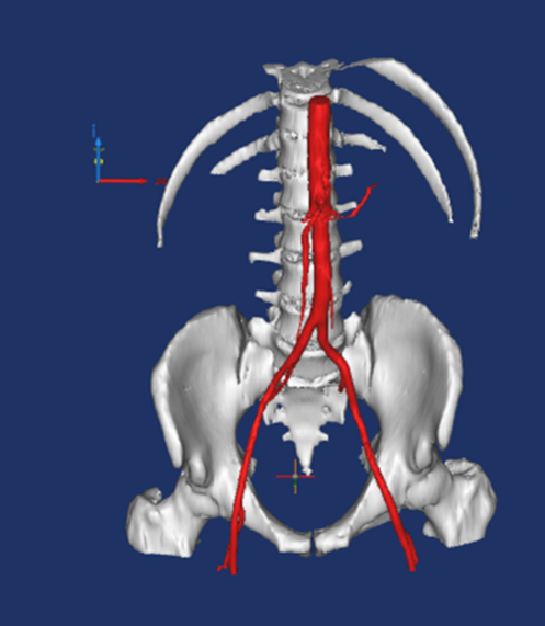 Photo of the path of an inferior vena cava's path down from the location of the heary through its biforcation just above the pelvis created via medical modeling software. 