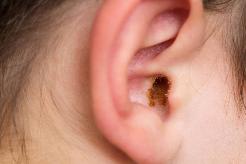 Ear with earwax in it